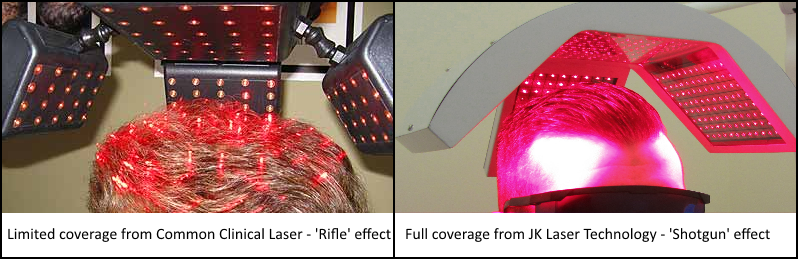 Laser Hair Therapy in Ireland