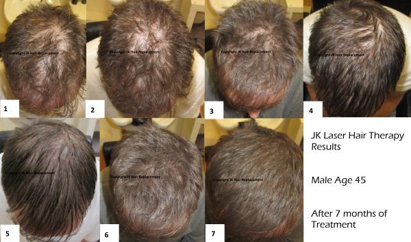 Laser Hair Therapy for Hair Regrowth for thinning Hair - JK Hair