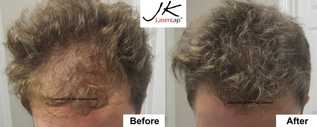 JK Laser Hair Therapy results