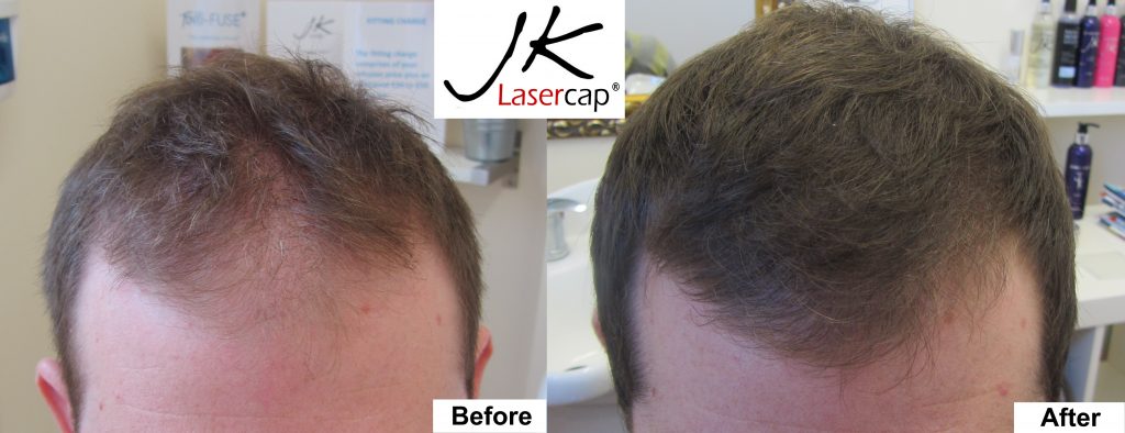 JK Laser Cap Guy before and after results Dublin